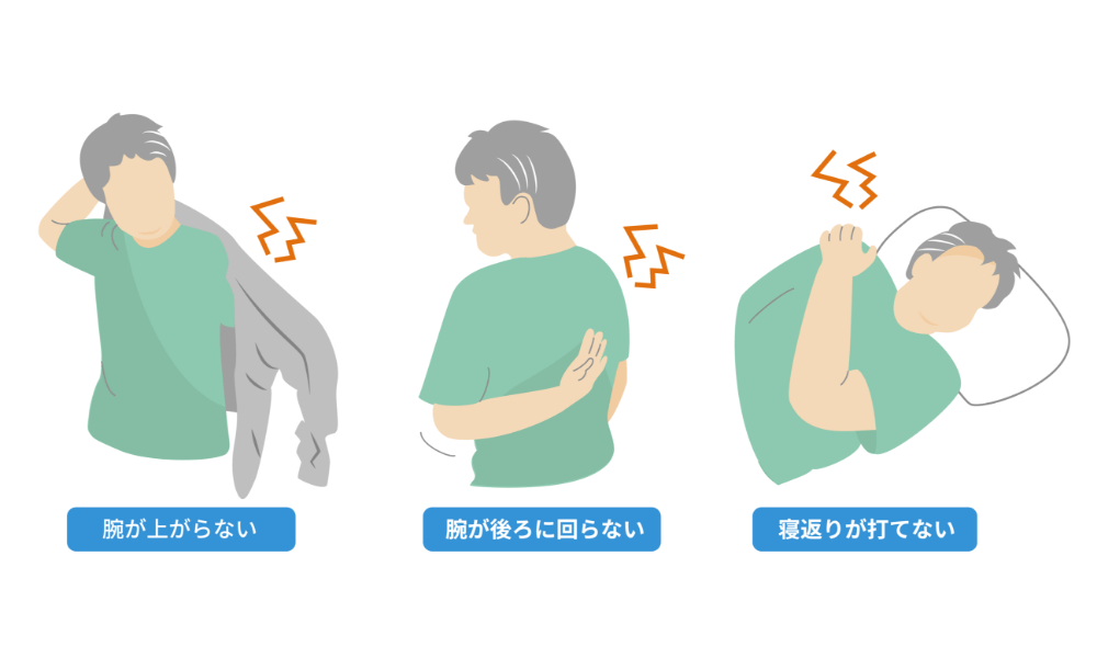 四十肩・五十肩の症状の特徴