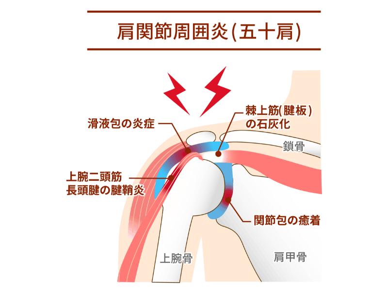 肩関節周囲炎